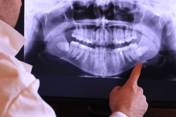 Best Emergency Dentist for Lost Fillings or Crowns in Gulf Breeze, FL